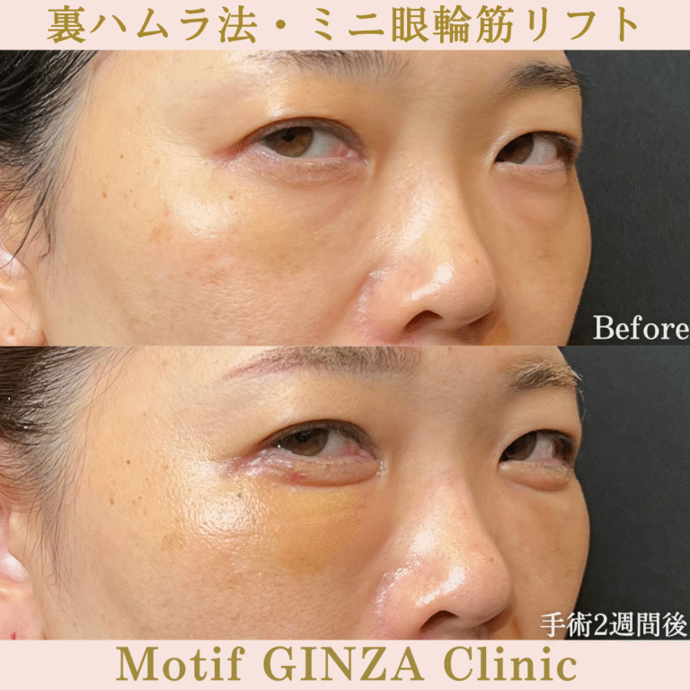 裏ハムラ法・ミニ眼輪筋リフト（手術１か月）の写真4