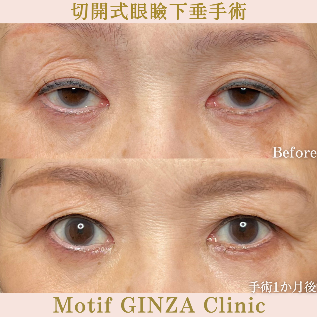切開式眼瞼下垂手術（手術6か月）の写真4