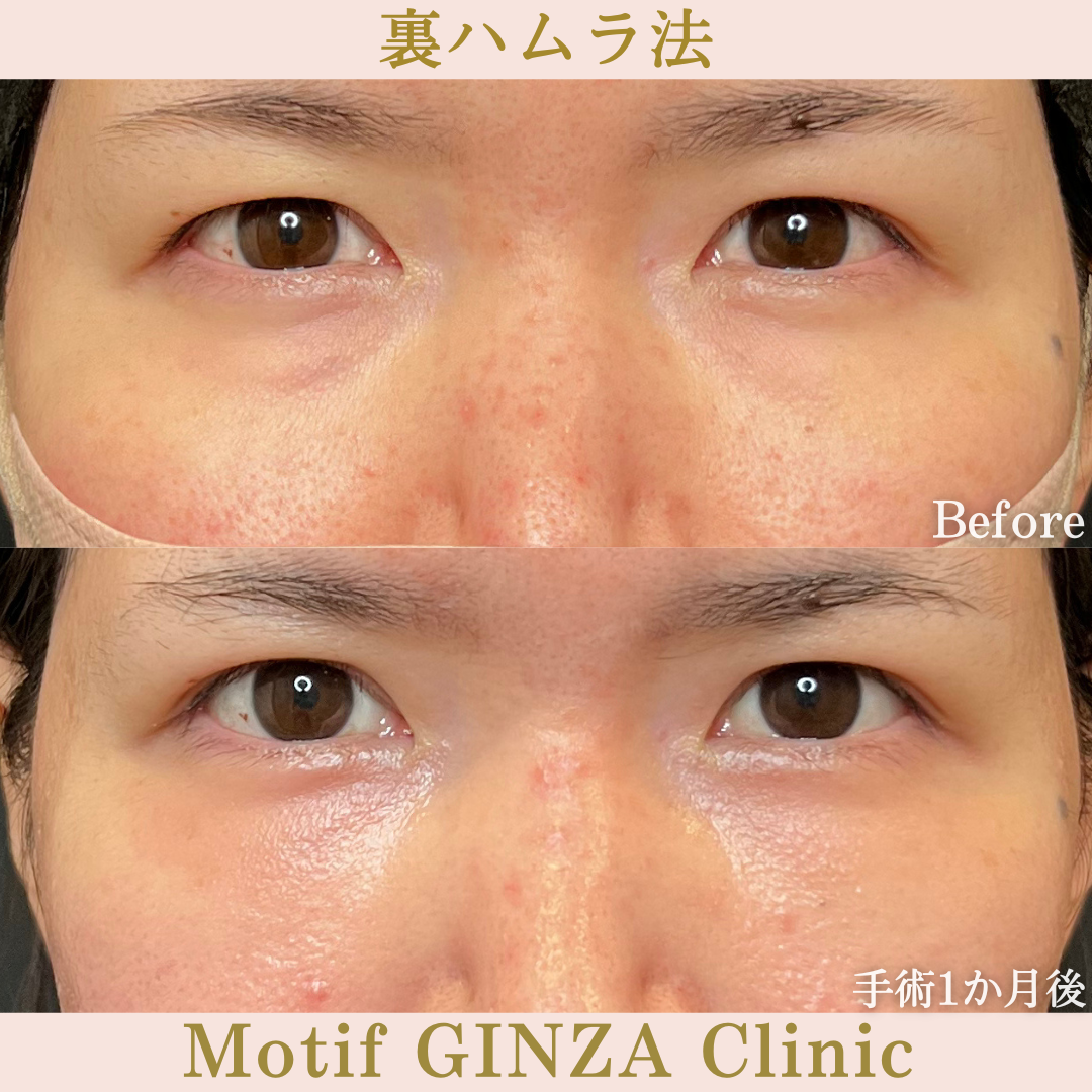 裏ハムラ法(手術3か月)の写真3