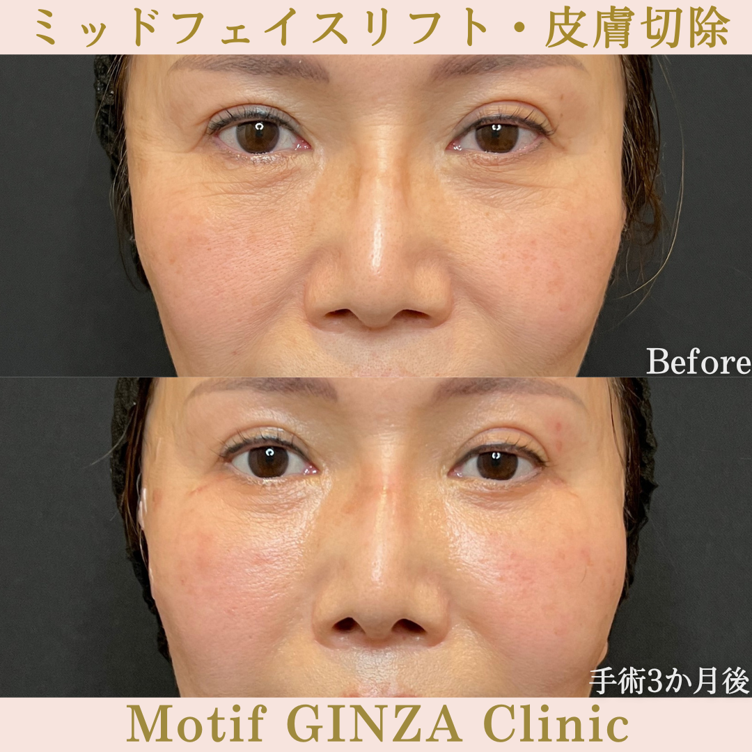 ミッドフェイスリフト・皮膚切除(手術6か月)の写真3
