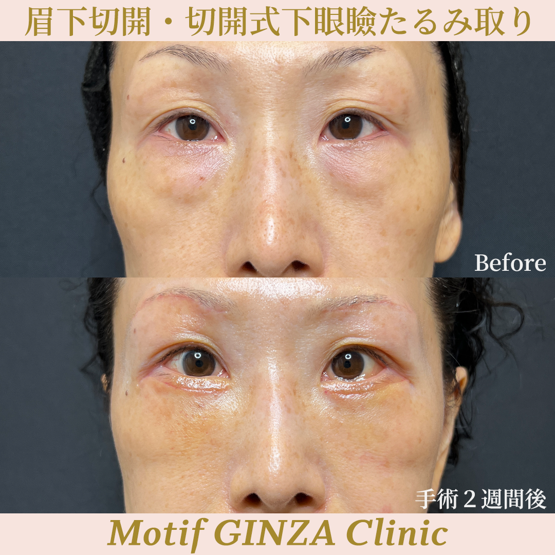 眉下切開・切開式下眼瞼たるみ取り(手術3ヶ月)の写真4