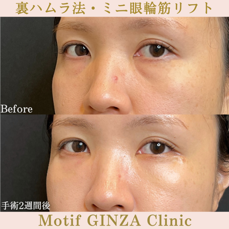 裏ハムラ法・ミニ眼輪筋リフト(手術1か月)の写真4