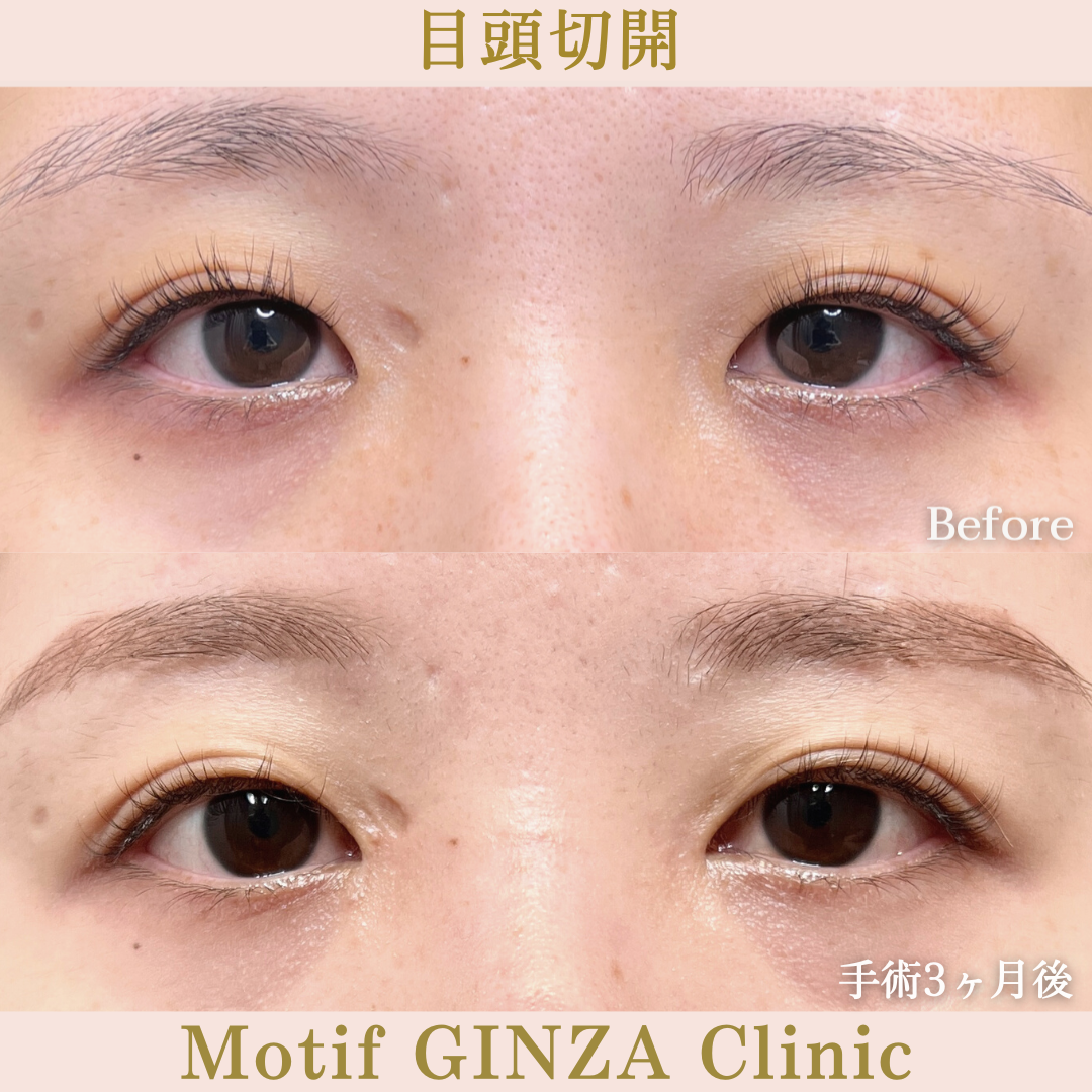 目頭切開手術（手術3ヶ月）の写真