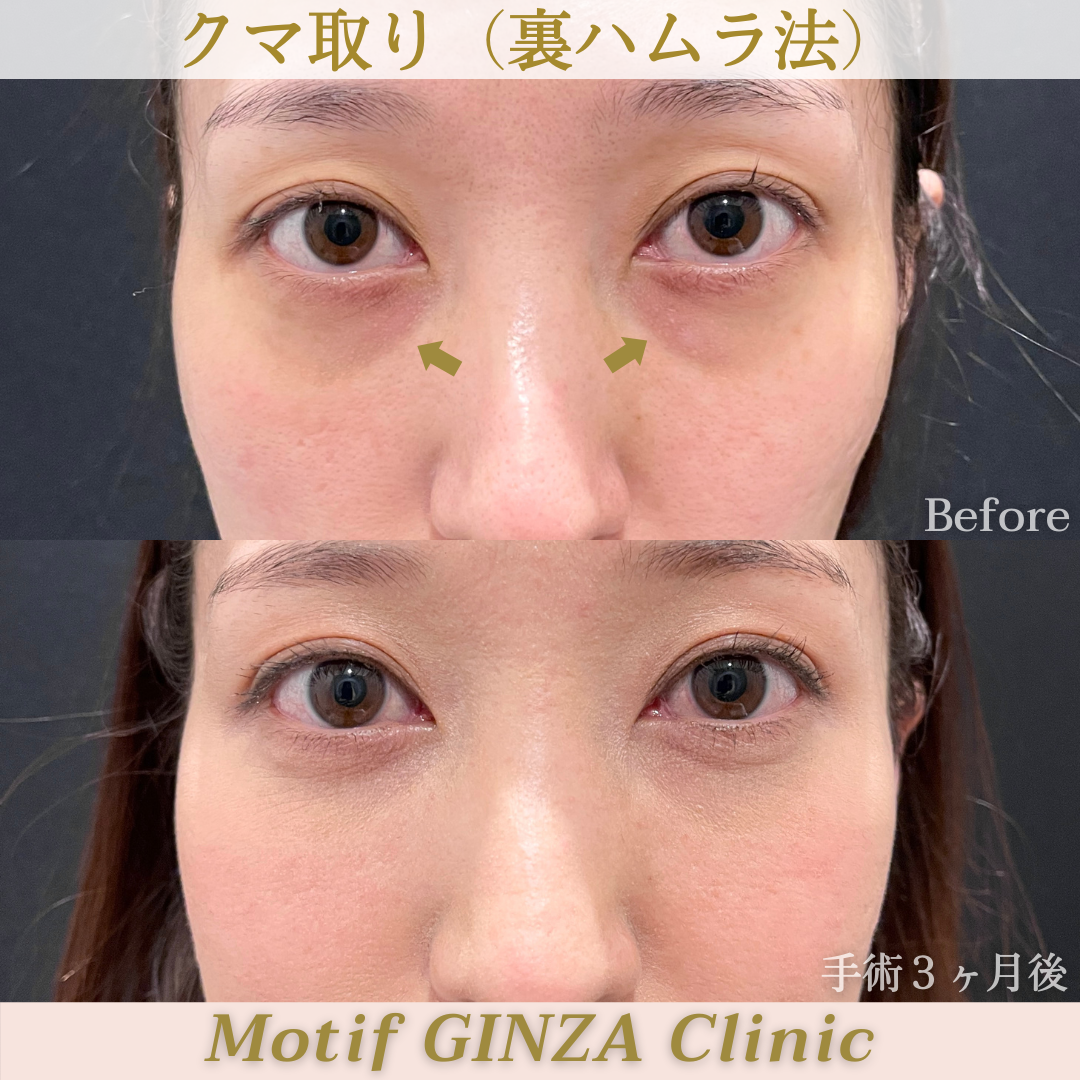 裏ハムラ法（手術３ヶ月）の写真