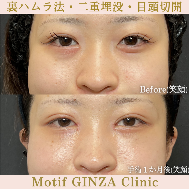 裏ハムラ法・二重埋没法・目頭切開(手術3か月)の写真3
