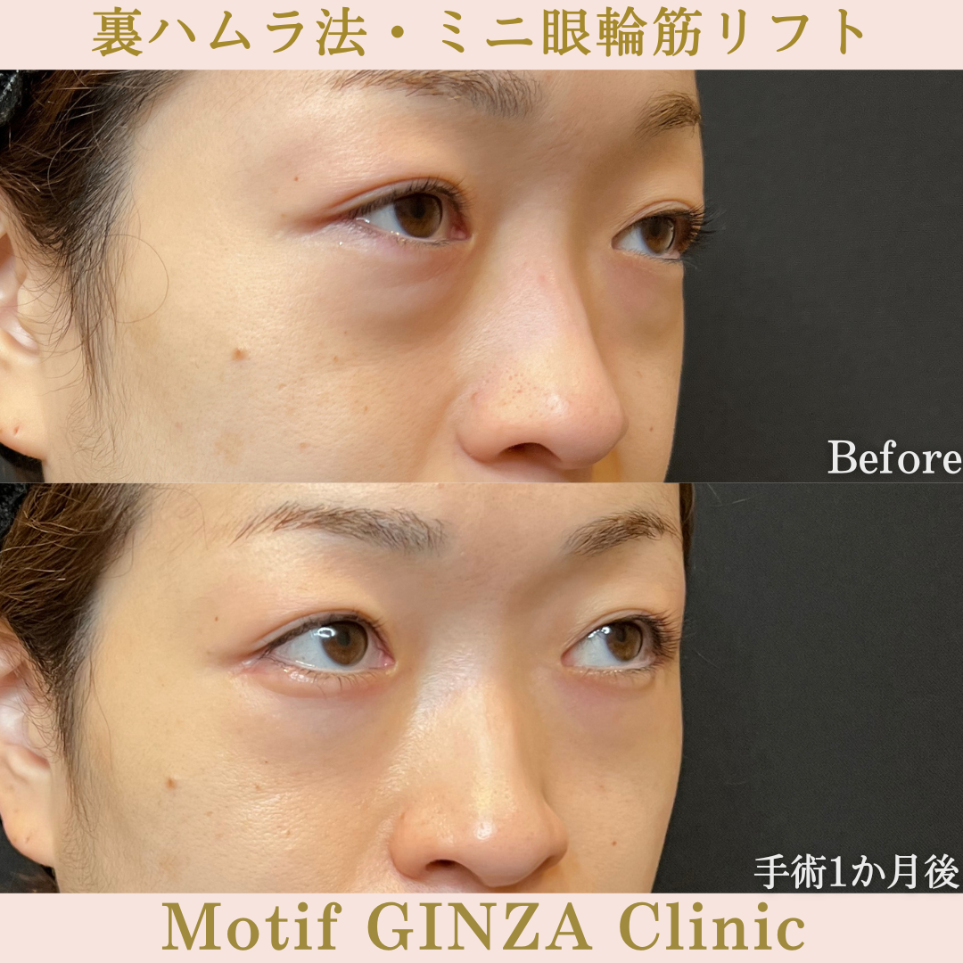 裏ハムラ法・ミニ眼輪筋リフト（手術1年8か月）の写真4