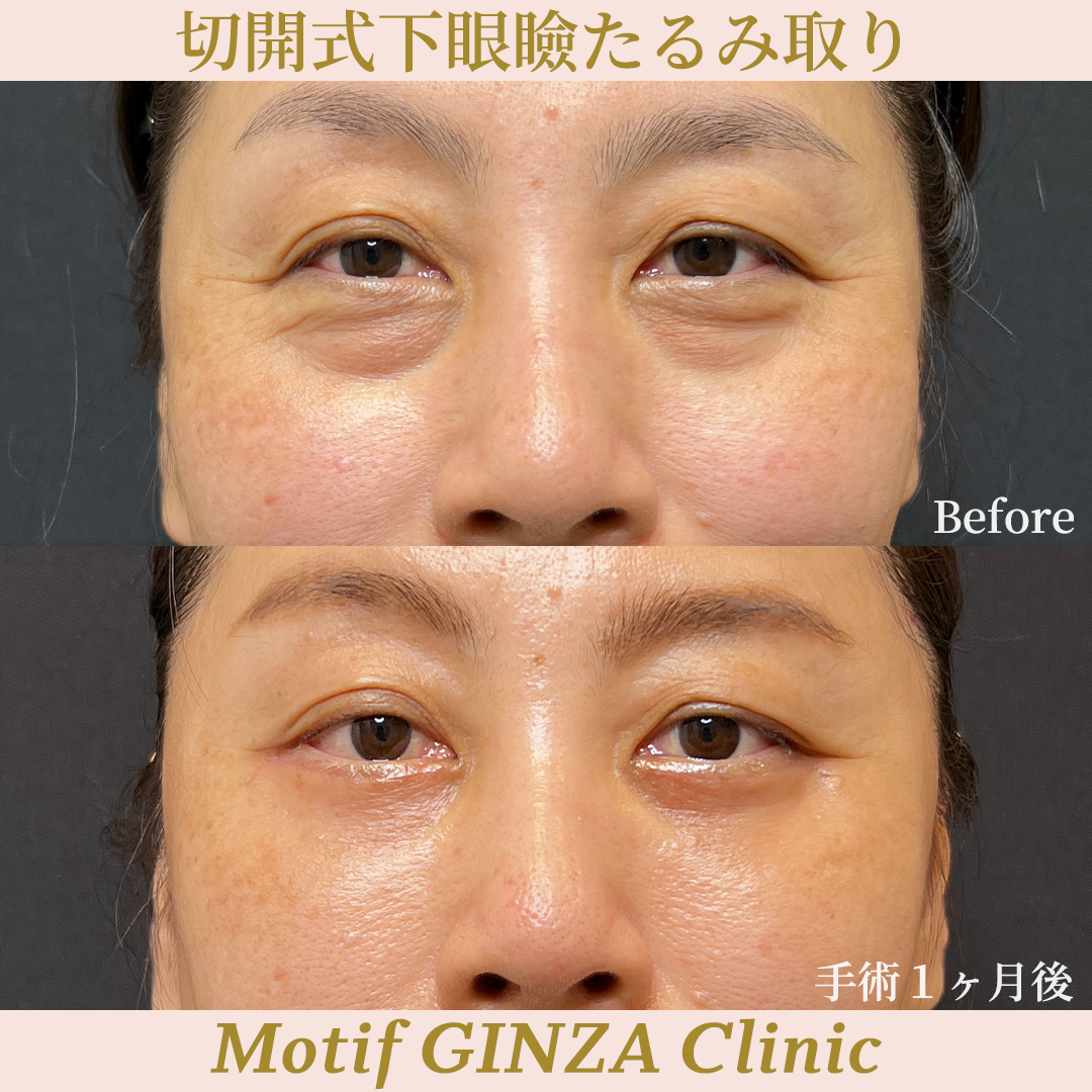 切開式下眼瞼たるみ取り（ハムラ法）（手術３ヶ月）の写真3
