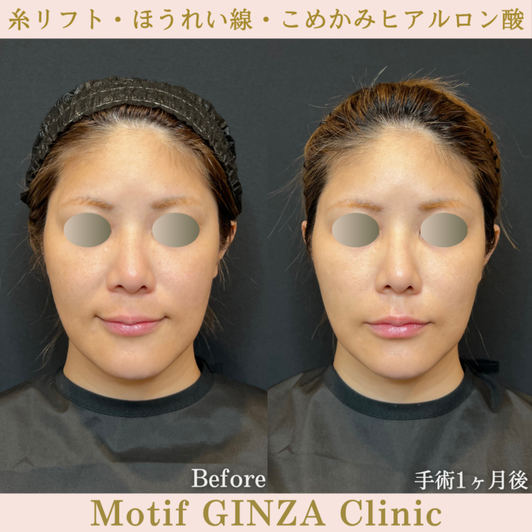 糸リフト・ほうれい線・こめかみヒアルロン酸（手術1か月）