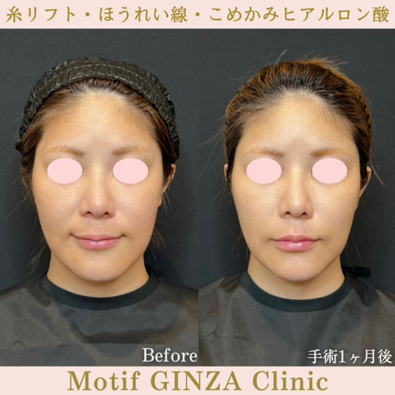 糸リフト・ほうれい線・こめかみヒアルロン酸（手術1か月）