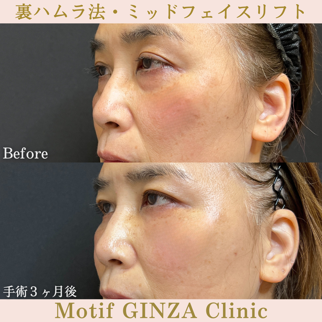 裏ハムラ法・ミッドフェイスリフト（手術3年7ヶ月）の写真4