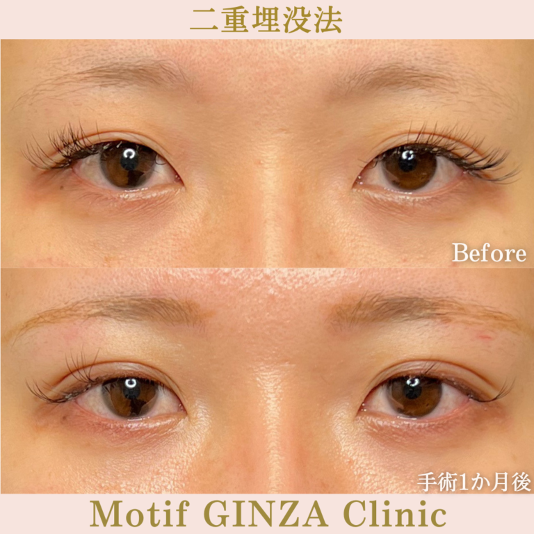 二重埋没法法（手術１か月）