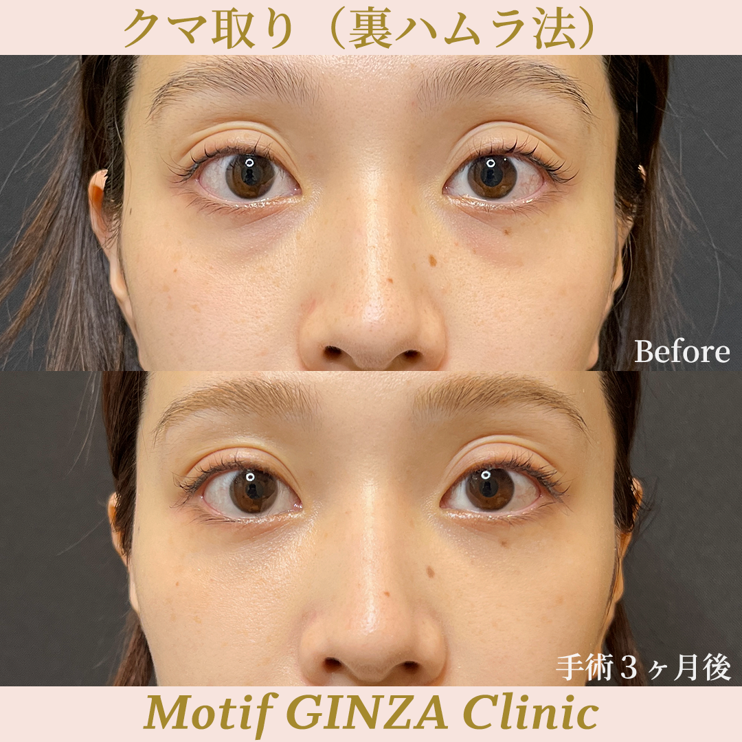 裏ハムラ法（手術３ヶ月）の写真