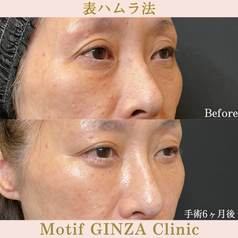 切開式下眼瞼たるみ取り（手術６か月）の写真2
