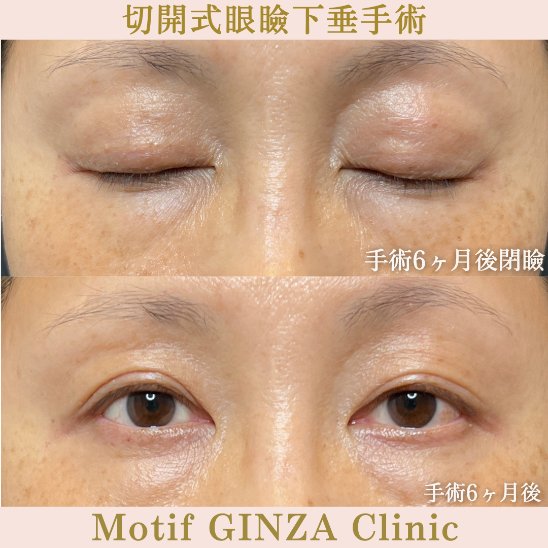 切開式眼瞼下垂手術（手術６ヶ月）の写真2