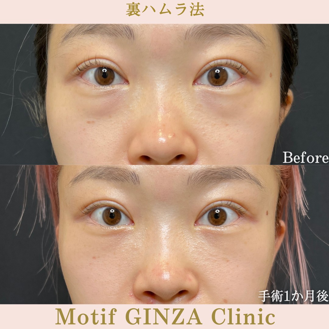 裏ハムラ法（手術１年９か月）の写真5