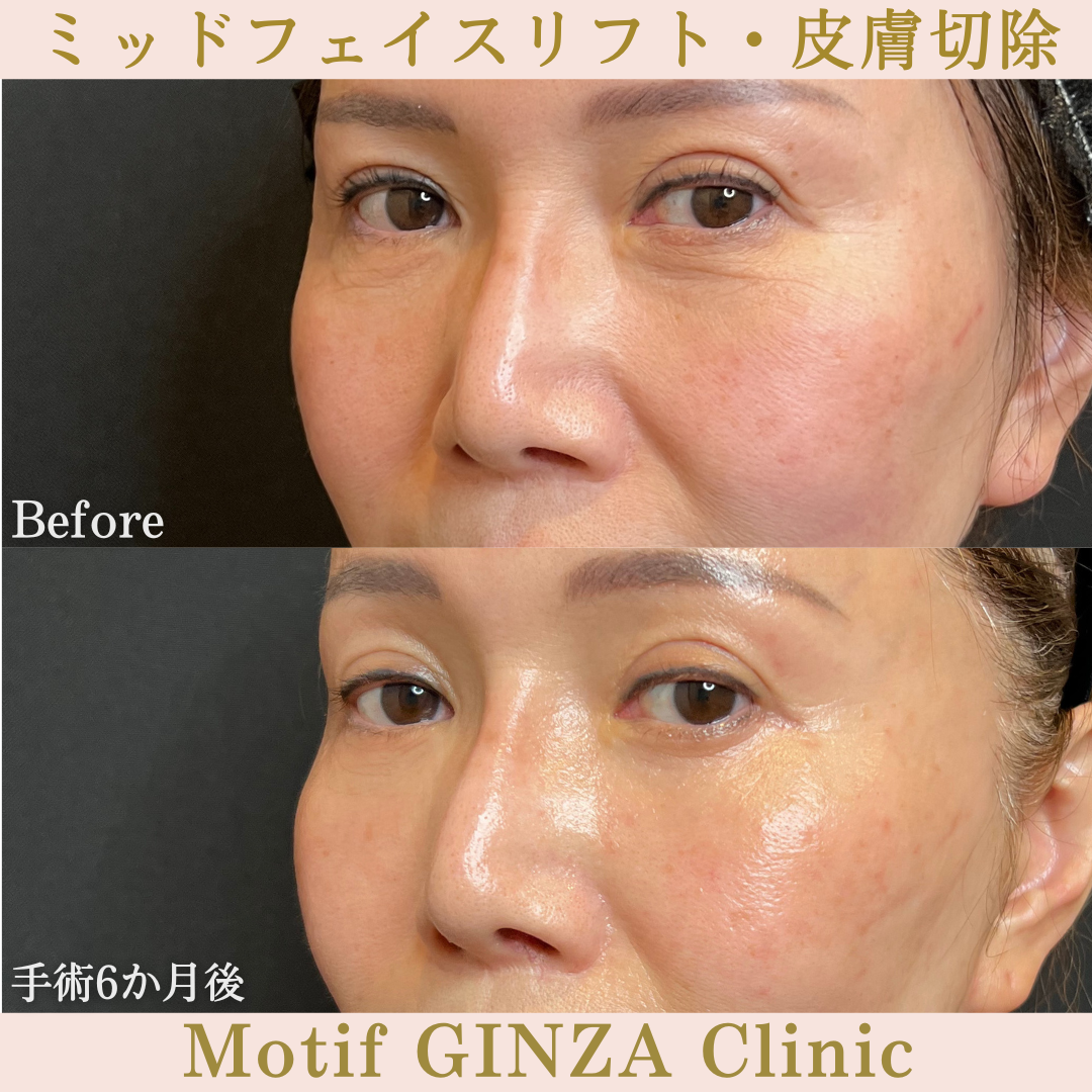 ミッドフェイスリフト・皮膚切除(手術6か月)の写真2