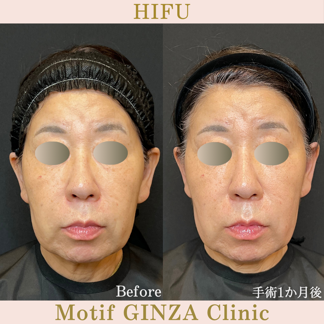 HIFU（手術1か月）の写真