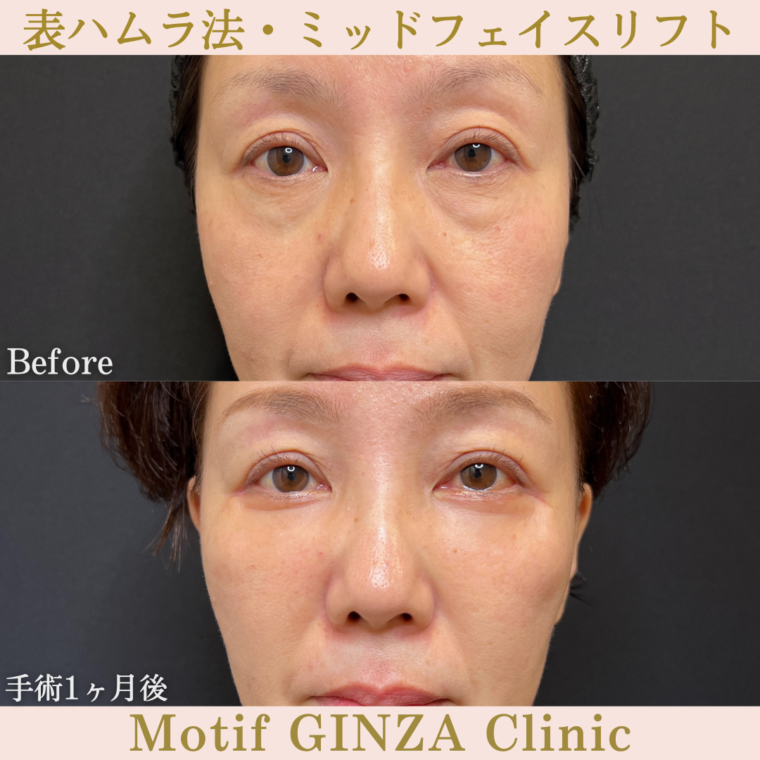 切開式下眼瞼たるみ取り・ミッドフェイスリフト(手術3ヶ月)の写真3