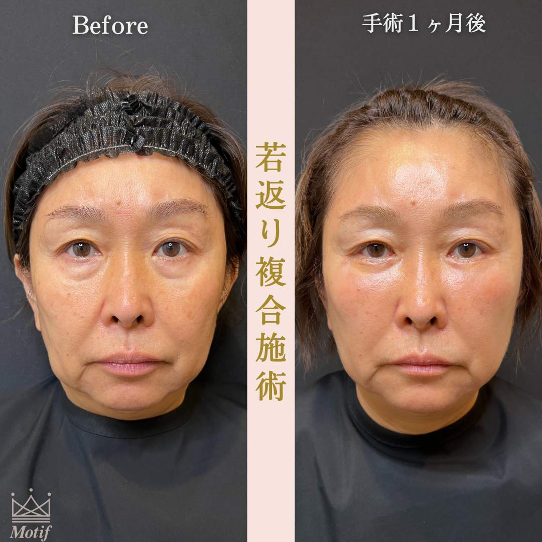 若返り複合施術（手術３ヶ月）の写真3