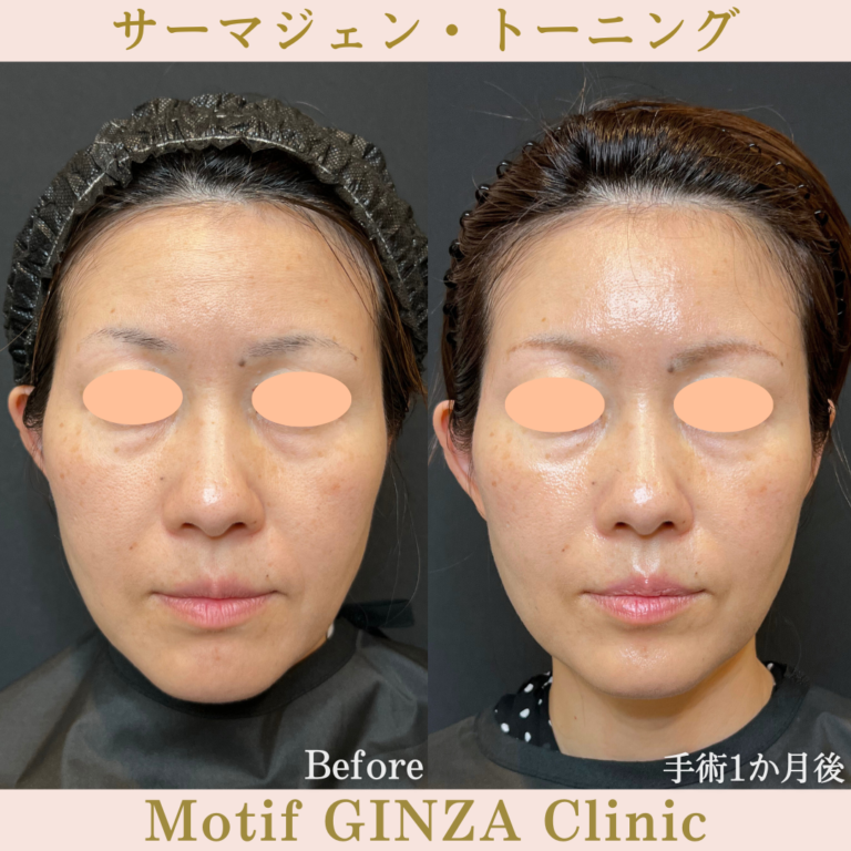 サーマジェン・トーニング（手術１か月）