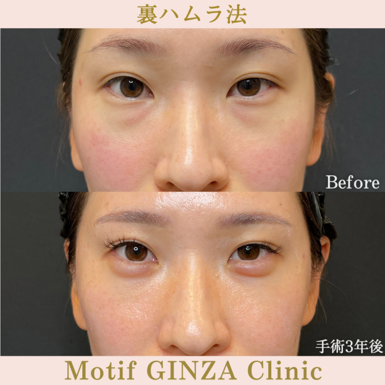 裏ハムラ法（手術3年）