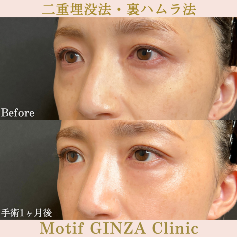 二重埋没法・裏ハムラ法（手術３か月）の写真4