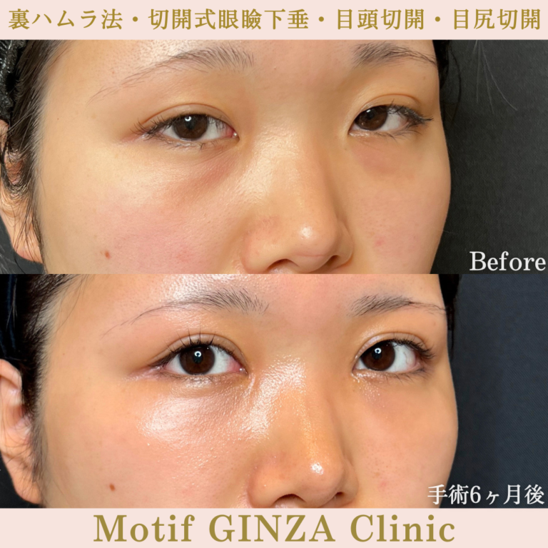 裏ハムラ法・切開式眼瞼下垂術・目頭切開・目尻切開(手術6か月)の写真3