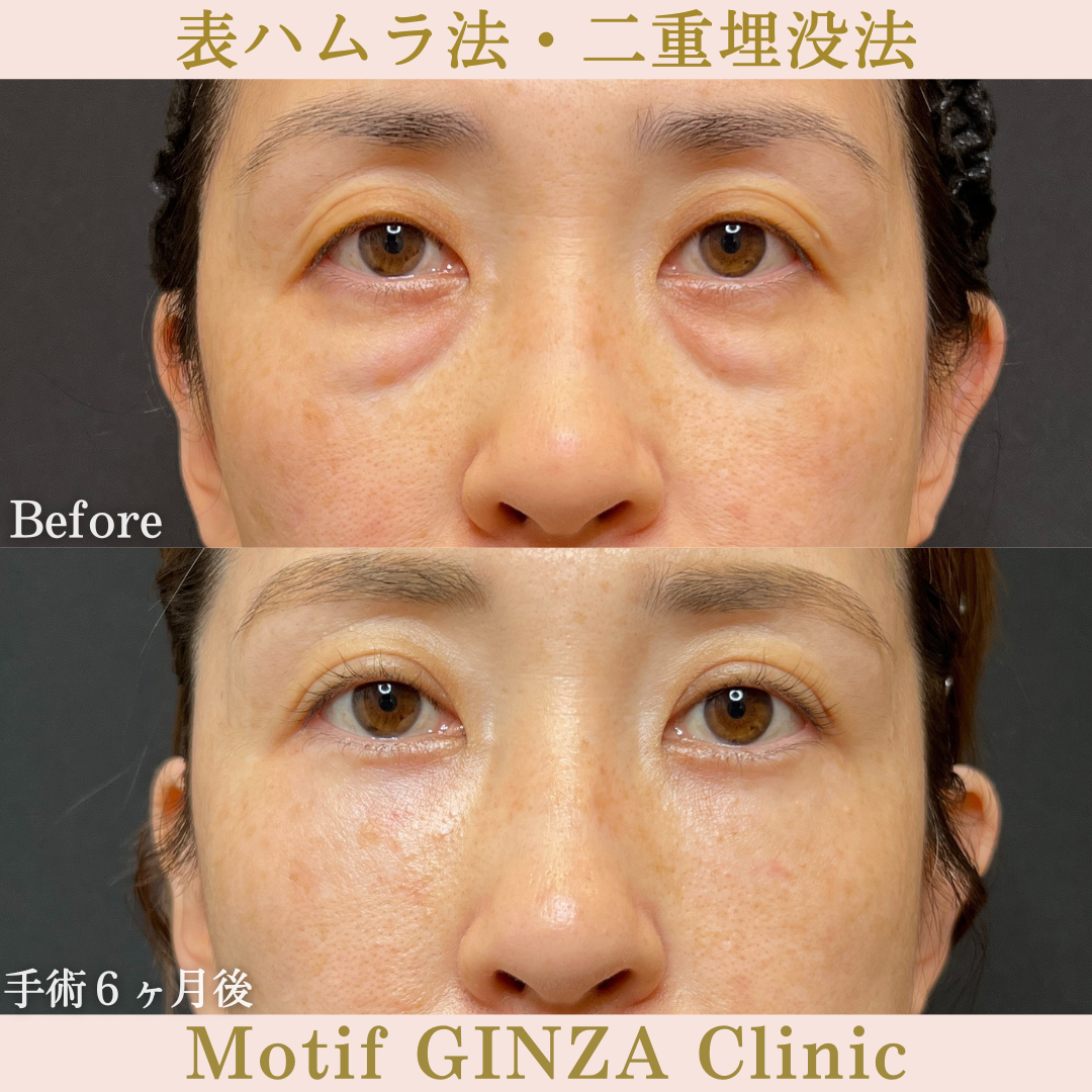 切開式下眼瞼たるみ取り・二重埋没法（手術６ヶ月）の写真