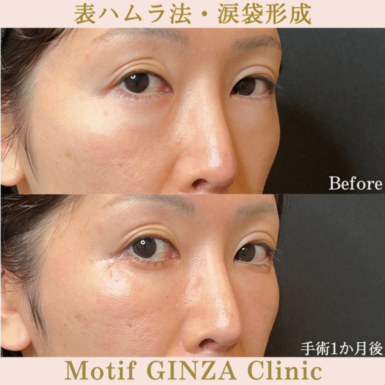 表ハムラ法・涙袋形成（手術３か月）の写真4