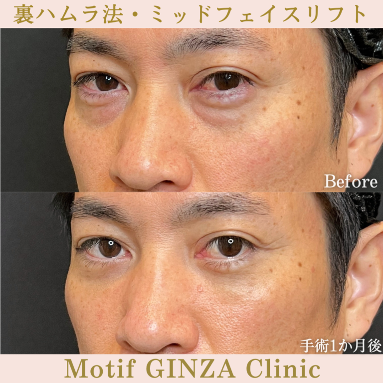 裏ハムラ法・ミッドフェイスリフト（手術1か月）の写真2