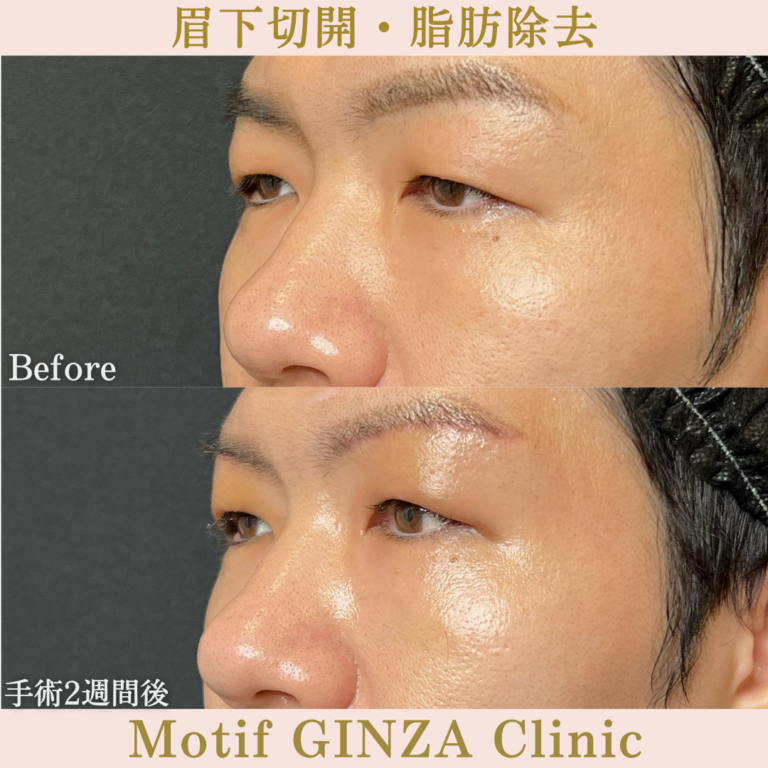 眉下切開・脂肪除去(手術3か月)の写真6
