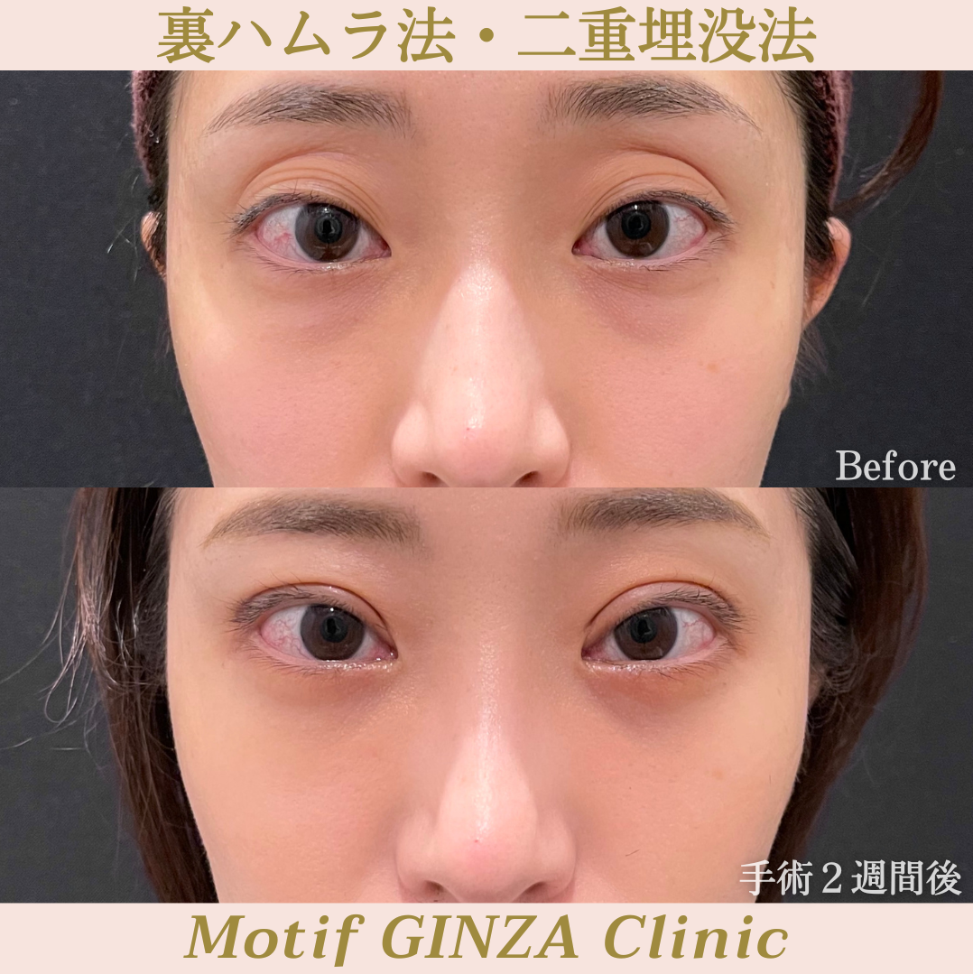 裏ハムラ法・二重埋没法（手術３ヶ月）の写真4
