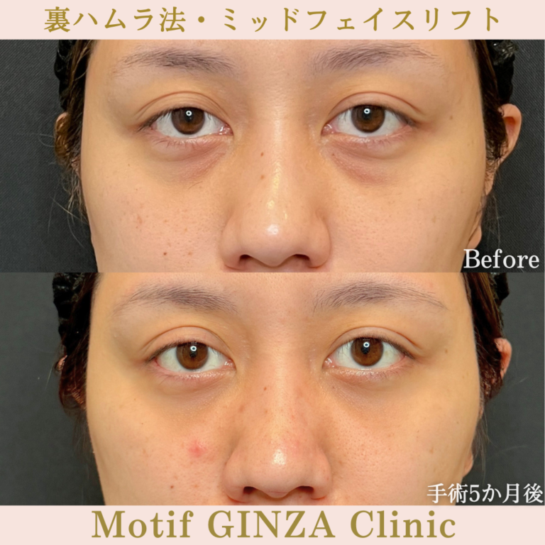 裏ハムラ法・ミッドフェイスリフト（手術5か月）