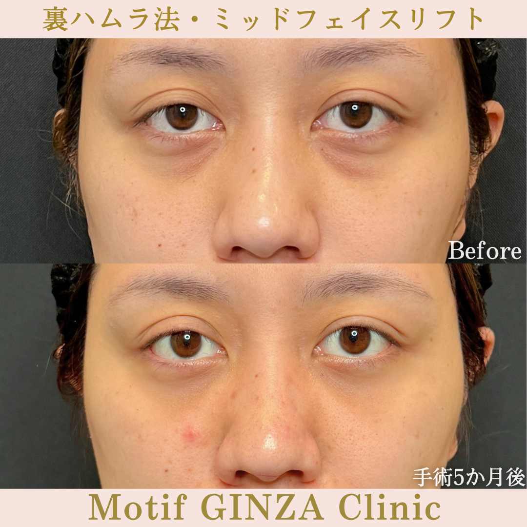 裏ハムラ法・ミッドフェイスリフト（手術5か月）の写真