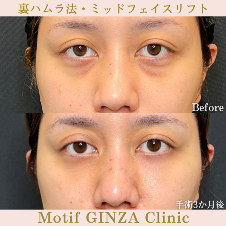 裏ハムラ法・ミッドフェイスリフト(手術5か月)の写真3