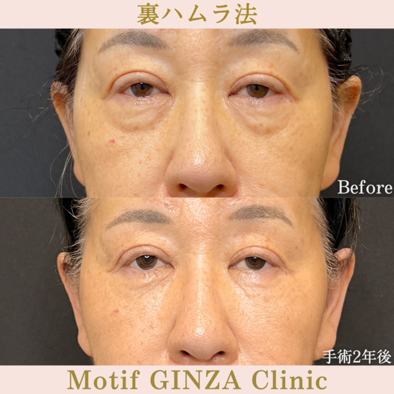 裏ハムラ法（手術2年後）