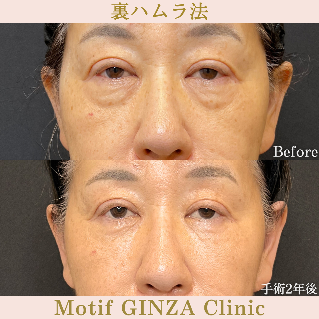 裏ハムラ法（手術2年）の写真