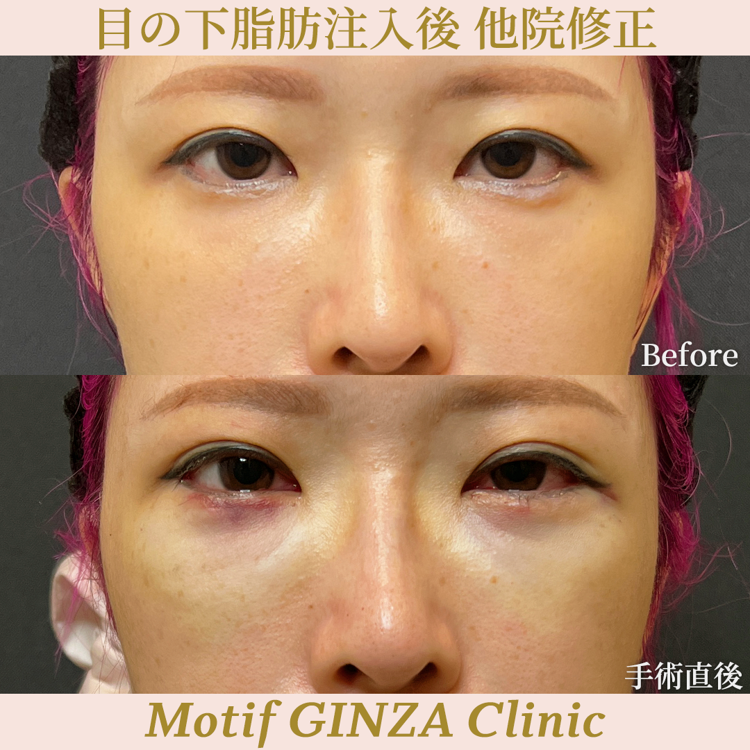 目の下脂肪注入後 他院修正（裏ハムラ法）（手術３ヶ月）の写真5