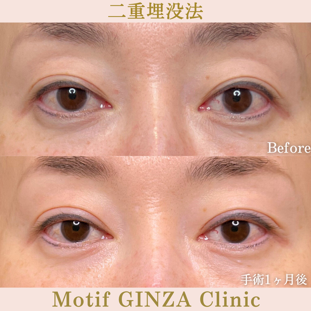 二重埋没法（手術１か月）の写真