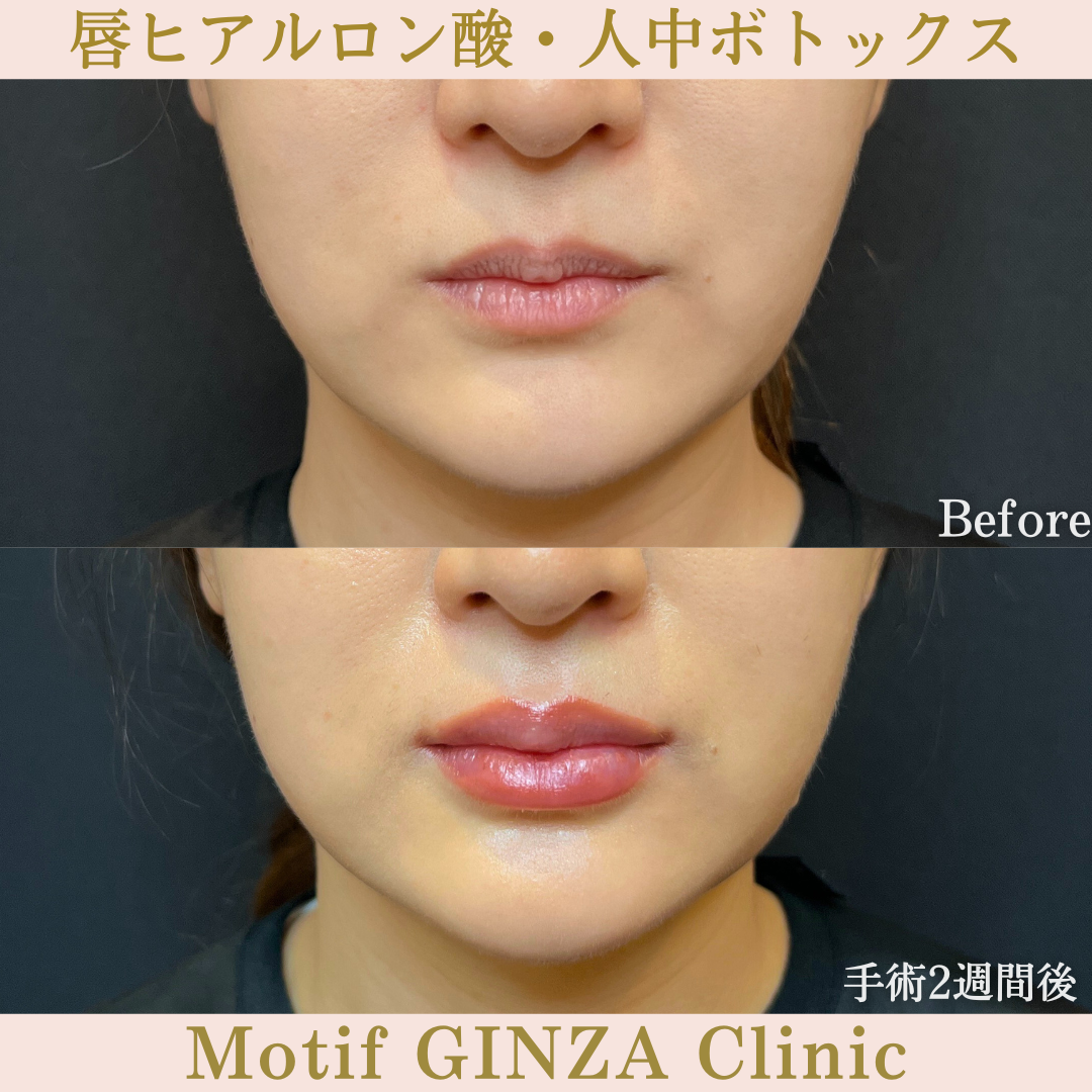 唇ヒアルロン酸・人中ボトックス（手術２週間）の写真