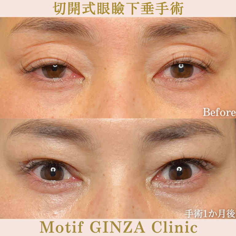 切開式眼瞼下垂手術（手術６か月）の写真4