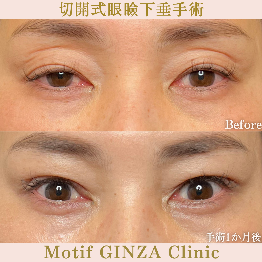 切開式眼瞼下垂手術（手術６か月）の写真4