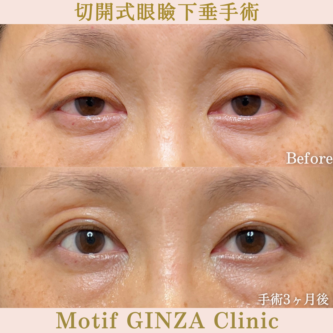 切開式眼瞼下垂手術（手術６ヶ月）の写真3