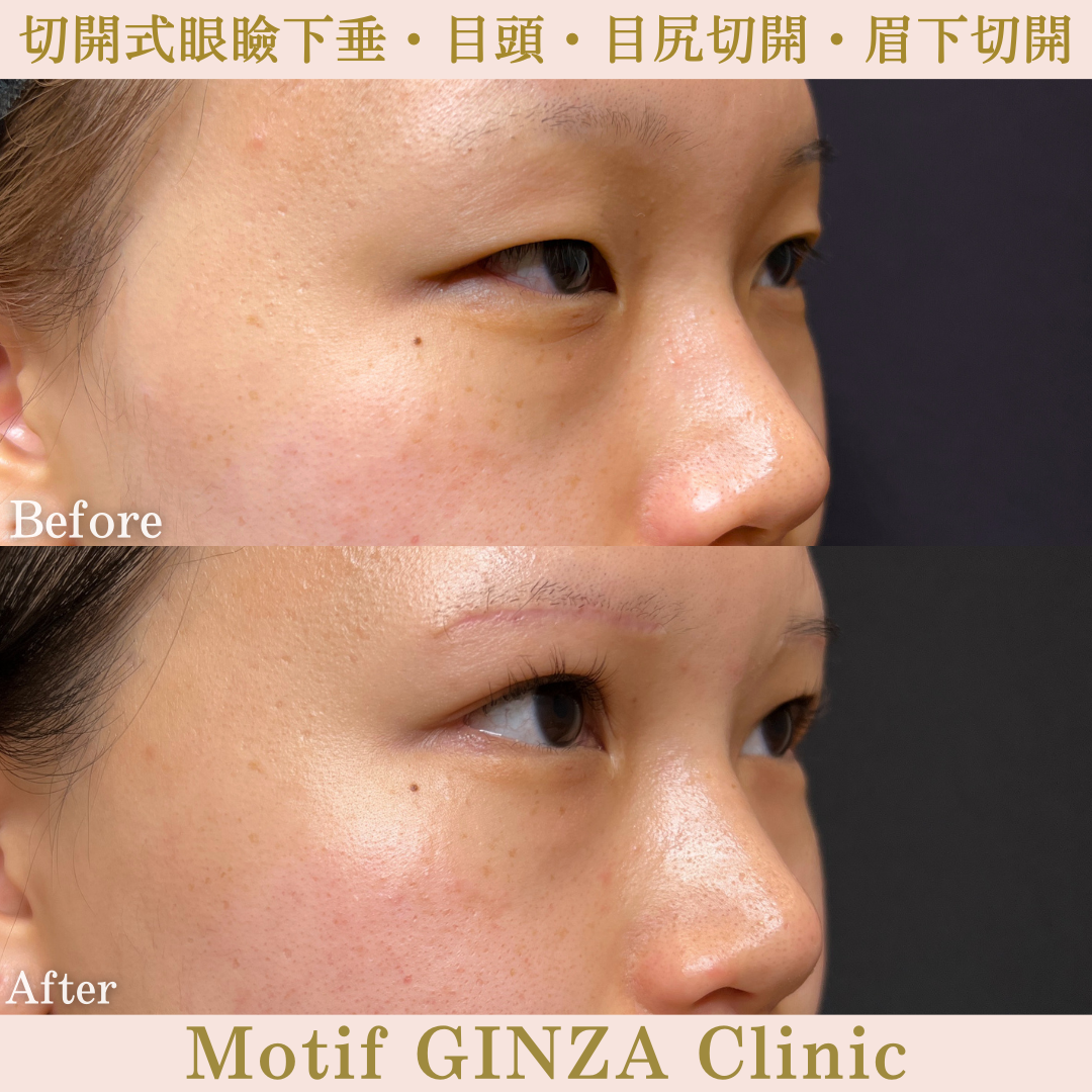 切開式眼瞼下垂・目頭切開・目尻切開・眉下切開（手術10ヶ月）の写真4