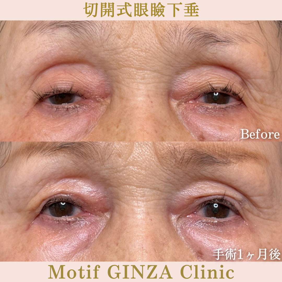 切開式眼瞼下垂手術(手術6か月)の写真4