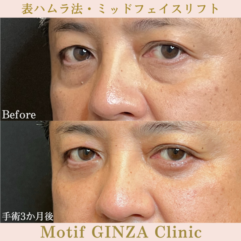 表ハムラ法・ミッドフェイスリフト（手術6か月）の写真4