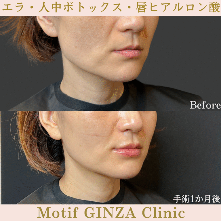 エラ・人中ボトックス・唇ヒアルロン酸（手術１か月）の写真2