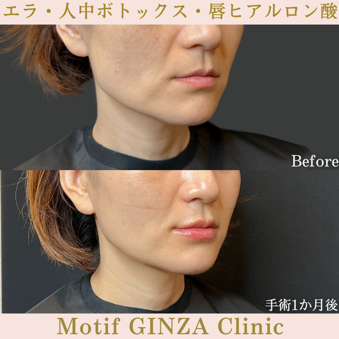 エラ・人中ボトックス・唇ヒアルロン酸(手術1か月)の写真2