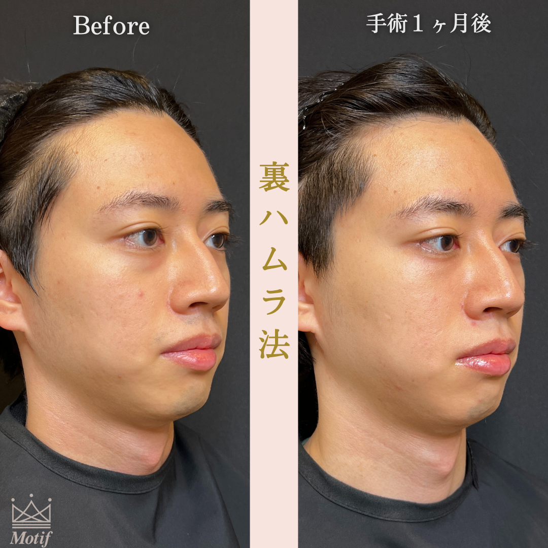 裏ハムラ法（手術３ヶ月）の写真4