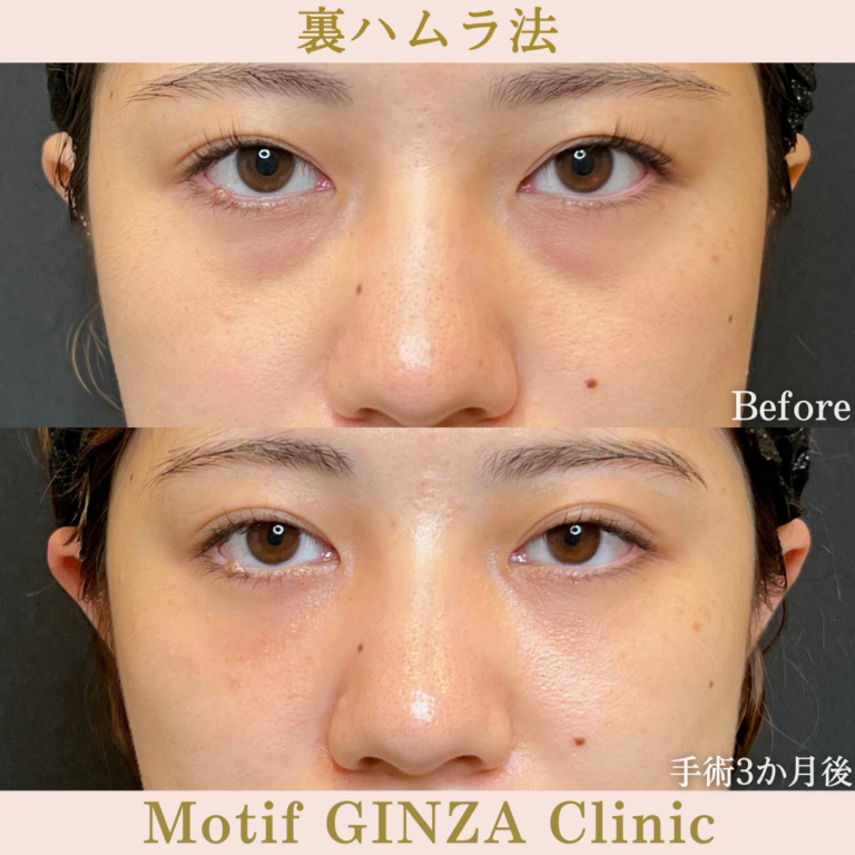 裏ハムラ法（手術３か月）